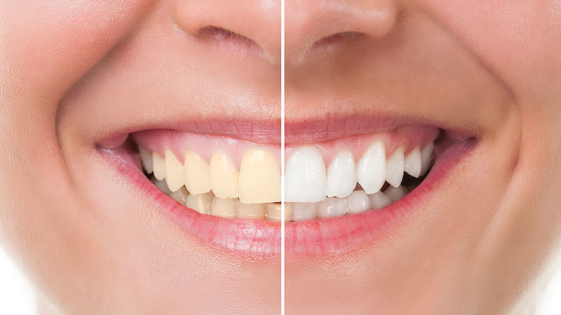 Boca con la mitad de los dientes blanqueados